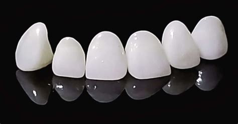 Carillas Dentales E Max Caracter Sticas Y Ventajas Cl Nica Dental