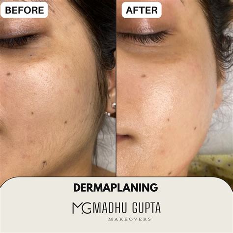 Dermaplaning Quanto Tempo Dura - Dermaplaning Preço Quanto Custa e Se Vale a Pena: A Verdade de 2026