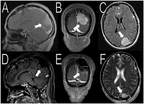 Frontiers Somatic Smarcb Mutation In Sporadic Multiple Meningiomas