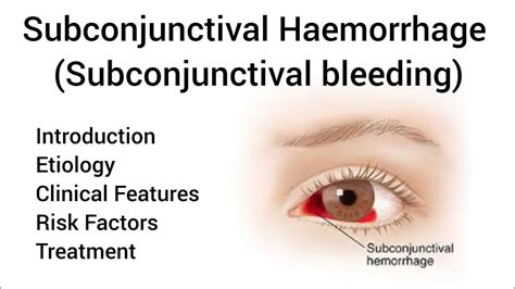 Subconjunctival Haemorrhage Subconjunctival Bleeding In Hindi