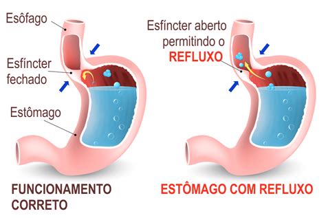 Doen A Do Refluxo Gastroesof Gico Tratamentos Que Funcionam