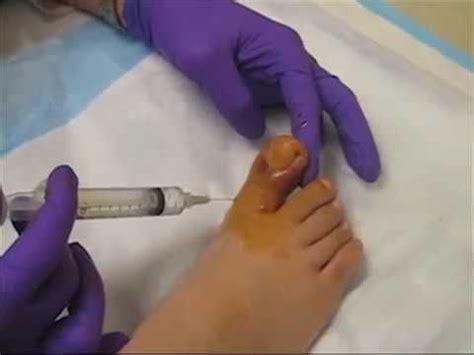 Remove Ingrown Toe Nail Artofit