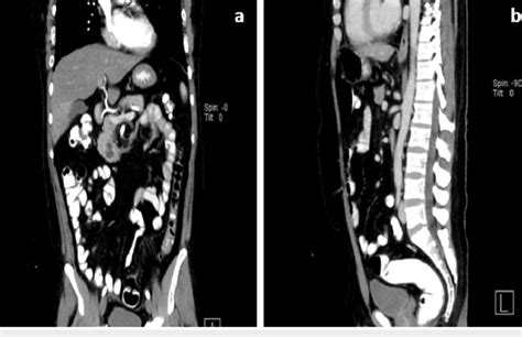 A double-contrast CT scan image. (a) Sagittal section and (b) coronal... | Download Scientific ...