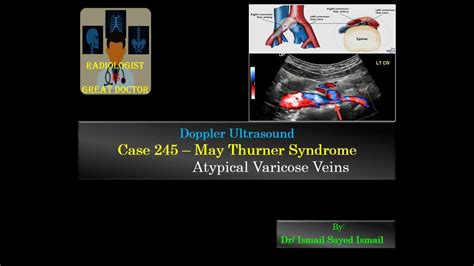 Ultrasound Case 245 May Thurner Syndrome Atypical V V Youtube