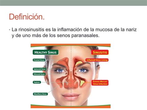 Rinosinusitis Aguda Y Cr Nica Ppt