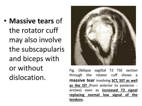 Mri Shoulder Joint With Common Pathologies Ppt