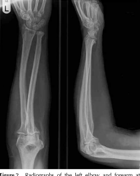 Proximal Radioulnar Joint