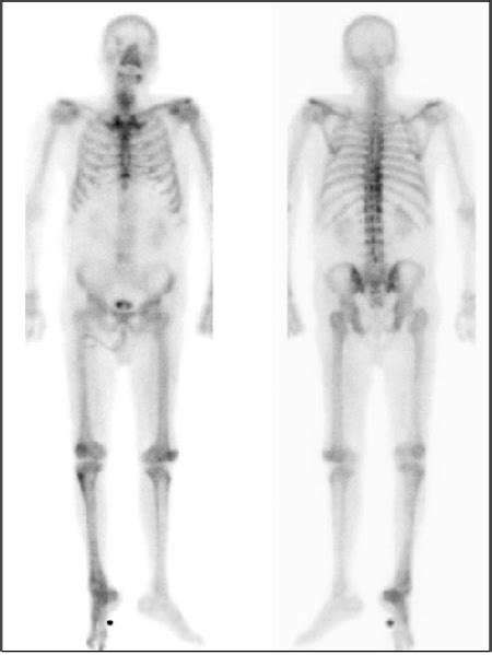 Bone scan shows no evidence of bone metastasis. | Download Scientific ...