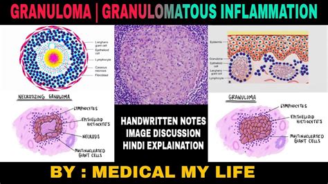 Granuloma Granulomatous Inflammation Types Of Chronic Inflammation Youtube