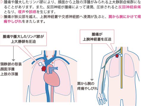 肺がん 看護roo カンゴルー