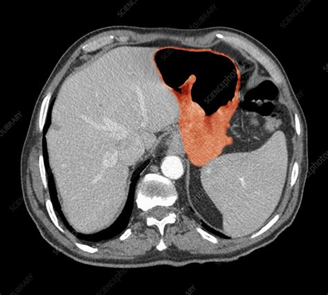 Stomach cancer, CT scan - Stock Image C021/3036 - Science Photo Library