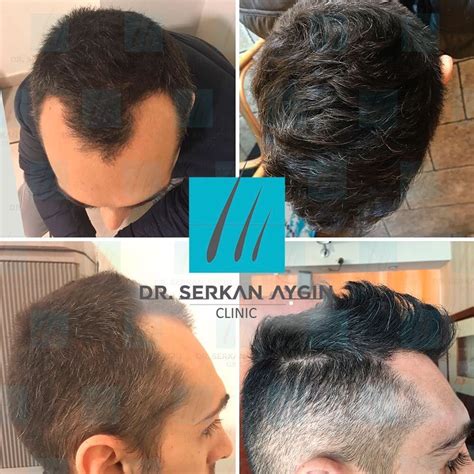 Trapianto Capelli Turchia Prezzo Bulbi Dr Serkan Aygin