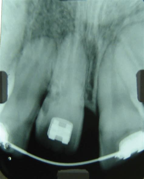 Intrabuccal Photographs And Periapical Radiograph Before Surgery