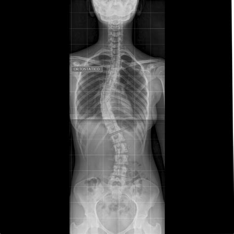 Raio X Panoramico Coluna - RX PANORÂMICO DE COLUNA VERTEBRAL - CDI Dr. Matsushita - Centro de ...