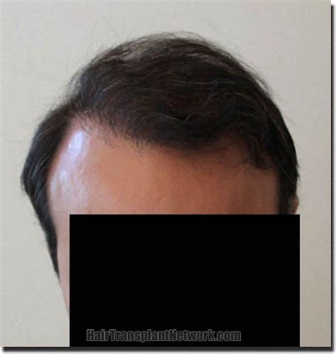 Dr. Ron Shapiro Hair transplant surgery before and after photos