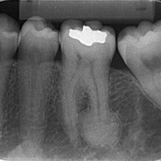 (PDF) Hypercementosis: Diagnostic imaging by radiograph, cone-beam computed tomography, and ...