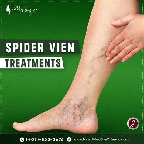 Spider Vein Treatment Artofit