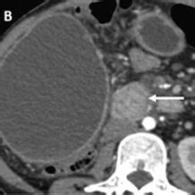 Pancreatic ductal adenocarcinoma. Axial ( ) and precontrast ( )... | Download Scientific Diagram