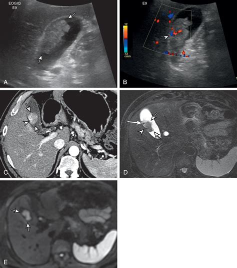 Neoplasms Of The Gallbladder And Biliary Tract Clinical Tree