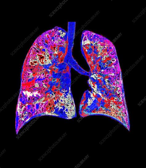 Healthy Lungs Ct Scan Stock Image F039 3324 Science Photo Library