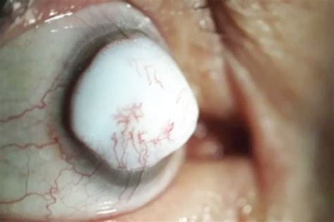 Grim Photos Show Giant White Lump Growing On Mans Eyeball After Cataract Op The Scottish Sun