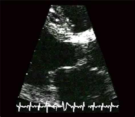 Figure 2 from Vascular and Valvular Calcifications in Chronic Kidney ...