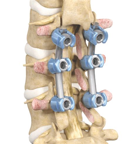 Lumbar Fusion Or Laminectomy Drew Albert Md Mba