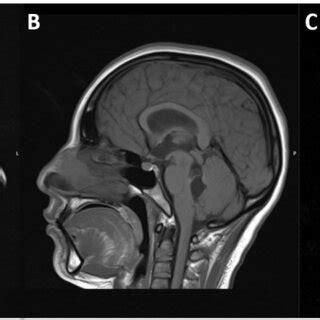 Preoperative Magnetic Resonance Imaging MRI Scans Showing Racemose