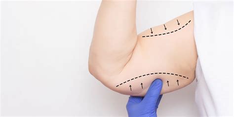 Braquioplastia Saiba Tudo Sobre A Cirurgia Pl Stica Nos Bra Os Dra