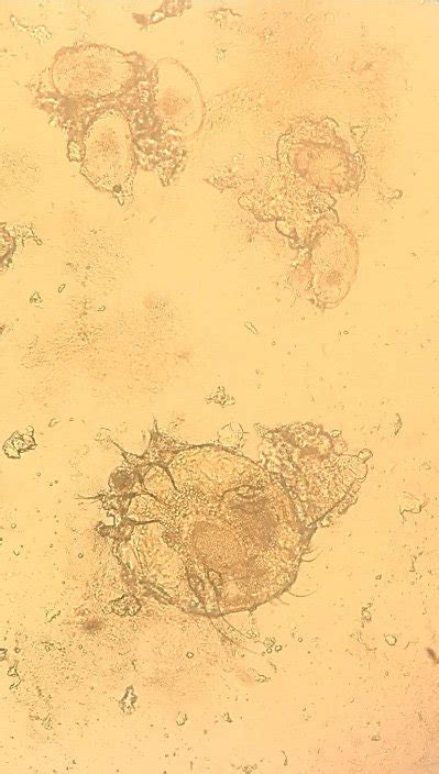 Scabies mite and eggs under light microscopy (mounted in KOHX400 ...