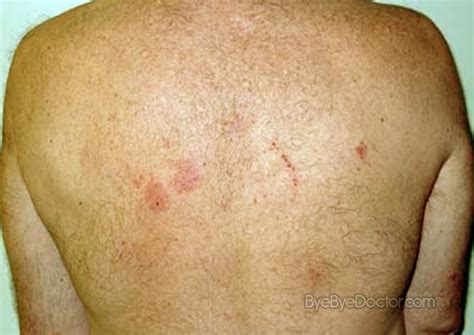 nummular dermatitis pictures - pictures, photos