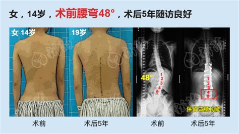 特发性脊柱侧弯手术 最大保留功能案例广东省新苗脊柱侧弯预防中心 脊柱侧弯新苗基金