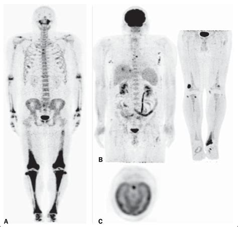 SciELO Brasil Complementary Findings On 18 F FDG PET CT And 18 F