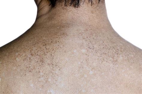 Sun Spots vs Freckles: What Are the Differences? – The District Weekly