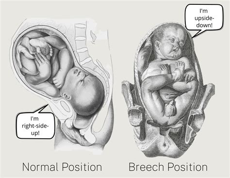 Weeks Pregnant Breech