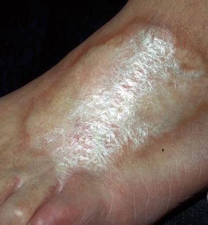 localized scleroderma - pictures, photos