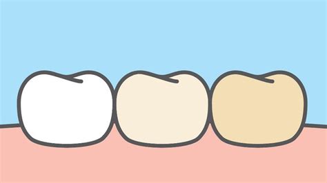 These Are The Things That Stain Your Teeth The Most Stained Teeth