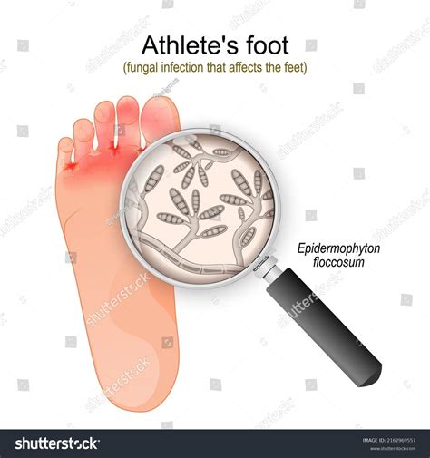 Athletes Foot Fungal Infection That Affects Stock Vector (Royalty Free ...