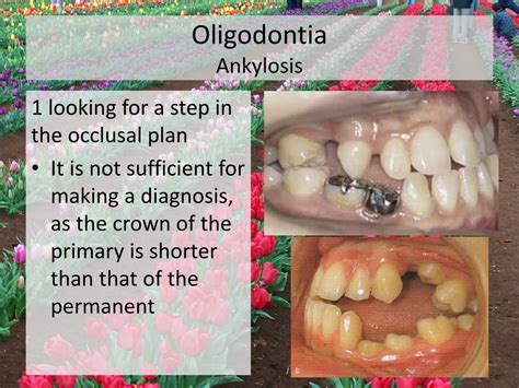 PPT - Oligodontia PowerPoint Presentation, free download - ID:1872529