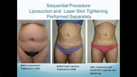 Liposuction Results Of Dr Goodman In Palm Beach Youtube