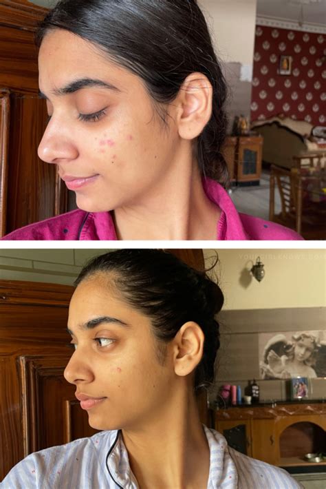 11 The Ordinary Products For Acne Scars That CHANGED My Skin