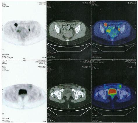 Figure 1 From Normal Size Ovary Carcinoma Syndrome With Inguinal Ovarian Cancer Lymph Node