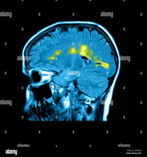 MRI of Multiple Sclerosis Stock Photo - Alamy