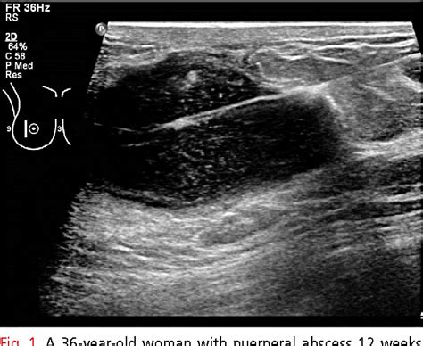 Figure From Comparison Of Needle Aspiration And Vacuum Assisted