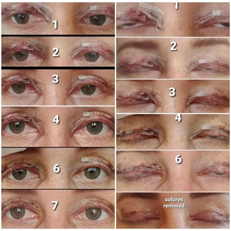 Blepharoplasty Week 1 Recovery Photos Open And Closed Eyes Follow Up