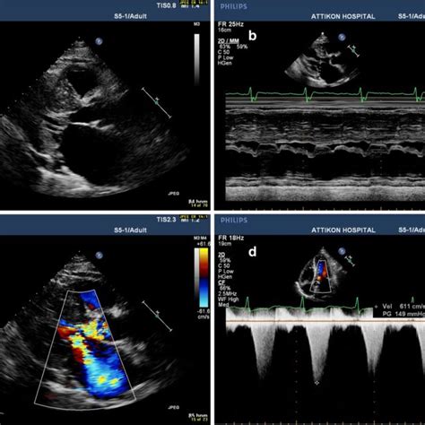 Hypertrophic Cardiomyopathy With Asymmetric Hypertrophy Of The