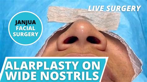 Alarplasty On Wide Nose Nostril Narrowing Live Surgery Dr