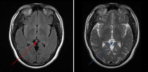 Pineal Cyst - DocNeuro