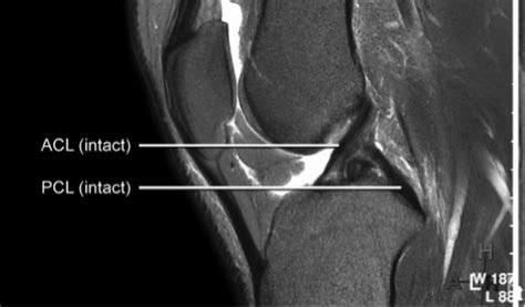 ACL Reconstruction - Ligaments and Joints Suregery