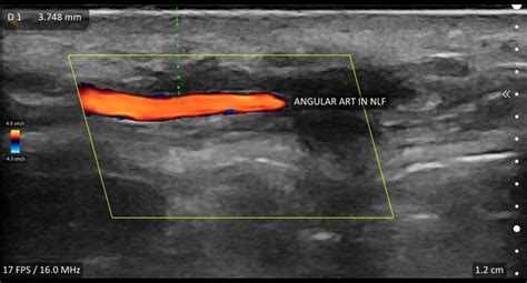 Ultrasound Scanning Filler Complications Harmony Medical Aesthetics